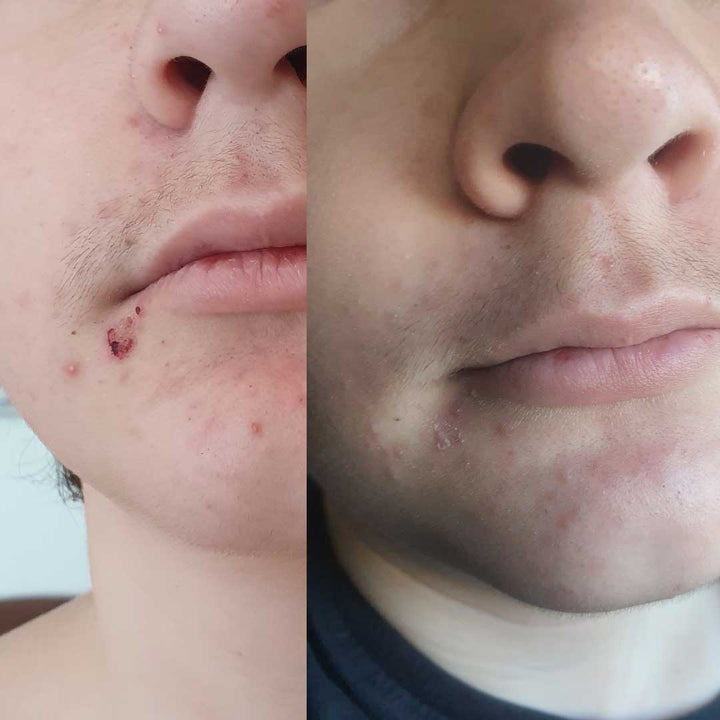 Smooth Start Essentials Kit | Acne & Body Bump Care for Boys & Men