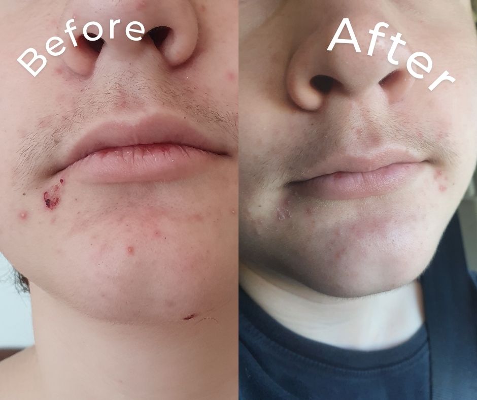 SPOT ERASER | Blemish Control Serum