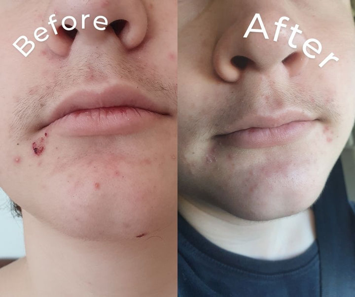 SPOT ERASER | Blemish Control Serum